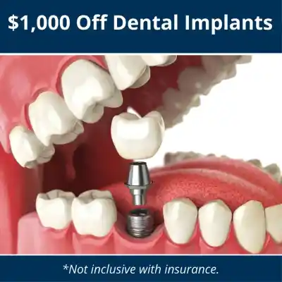 Dental implant special